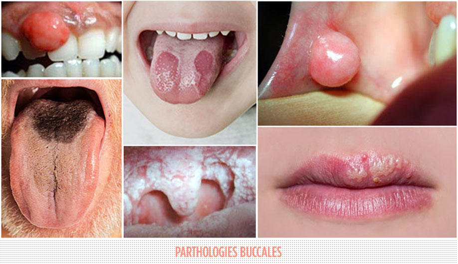 pathologies buccales