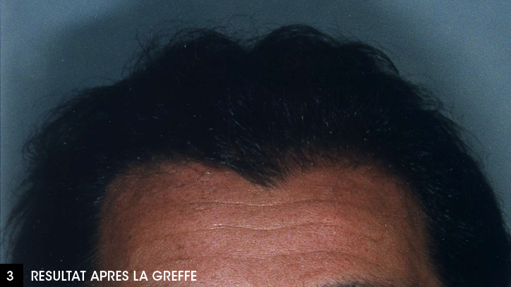 après la greffe de cheveux