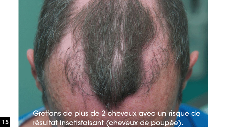 greffons de plus de 2 cheveux 