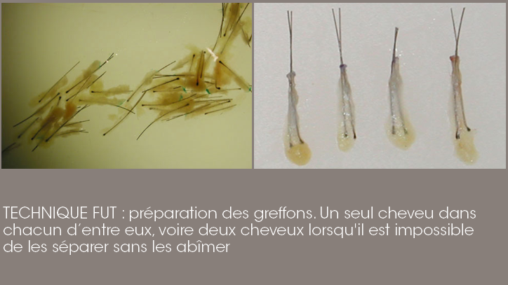 greffons : un seul cheveu par greffon