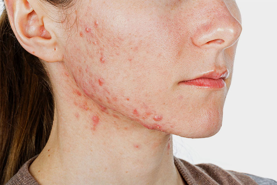 dermatologie chirurgicale acné