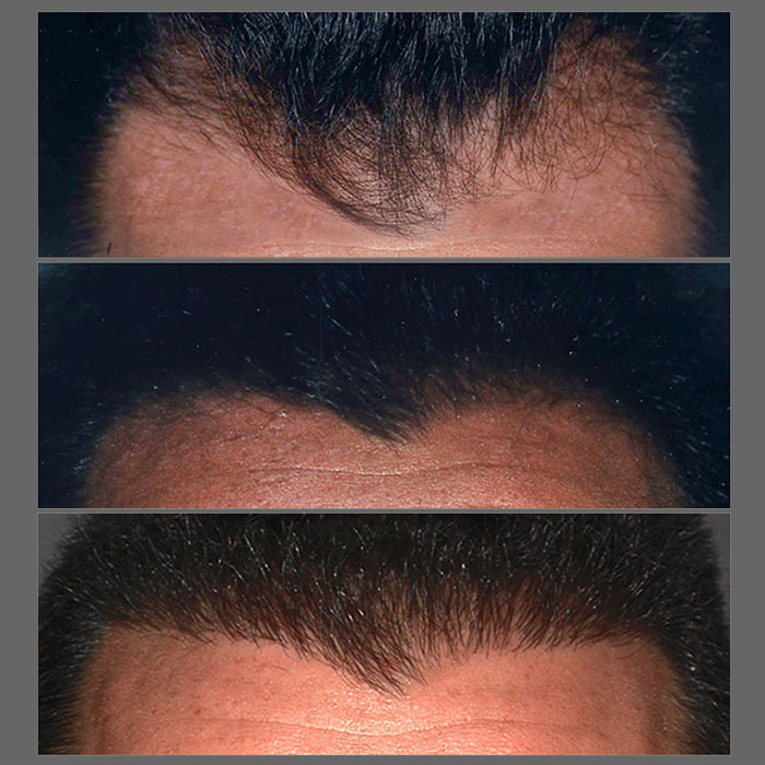 microgreffes de cheveux greffe de cheveux