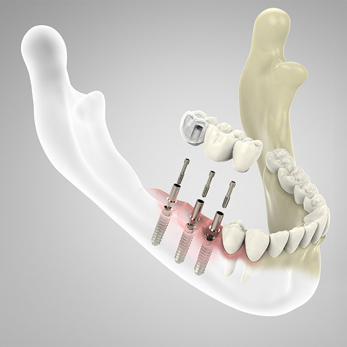 Chirurgie pré-implantaire, greffe osseuse pré-impantaire, matériaux de comblement osseux, péri-implantite Implants dentaires